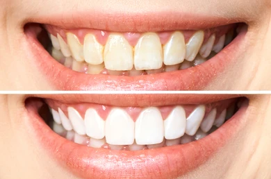 TEETH WHITENING/ BLEACHING
