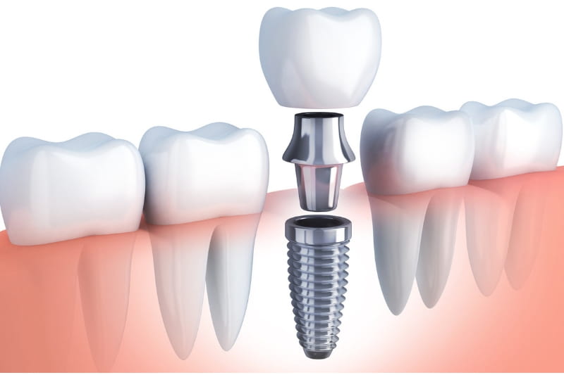 Smiles Central - Latest update - Dental Implants Clinic Near Kasavanahalli
