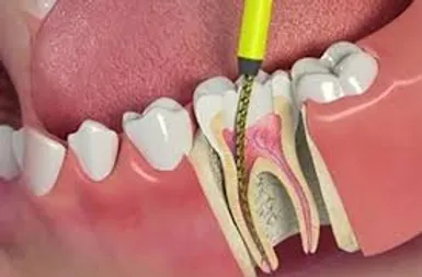 Smiles Central - Service - Root Canal Treatment (RCT)