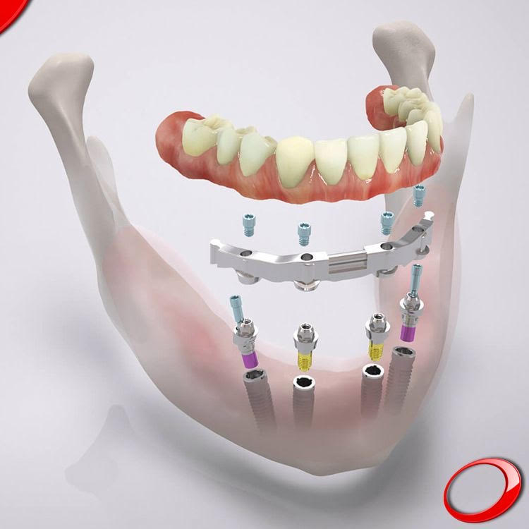 Smiles Central - Service - Dental Implants