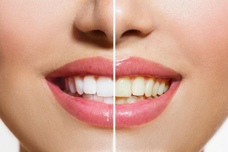 Smiles Central - Teeth whitening