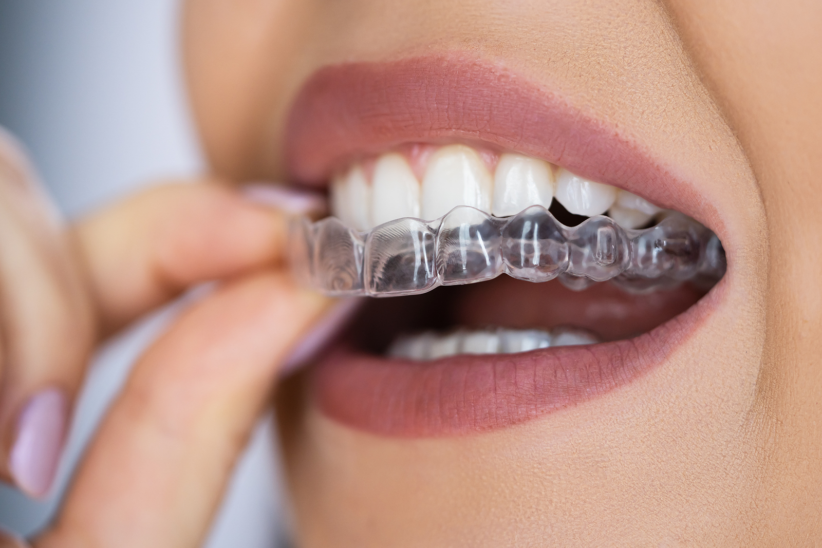 Smiles Central - Latest update - Cure For Dental Aligners In Bellandur