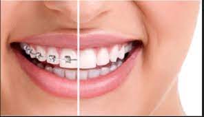 Smiles Central - Latest update - Cure For Dental Aligners In Bellandur