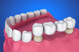 Smiles Central - Latest update - Replacement Of Missing Teeth Dental Near Haralur