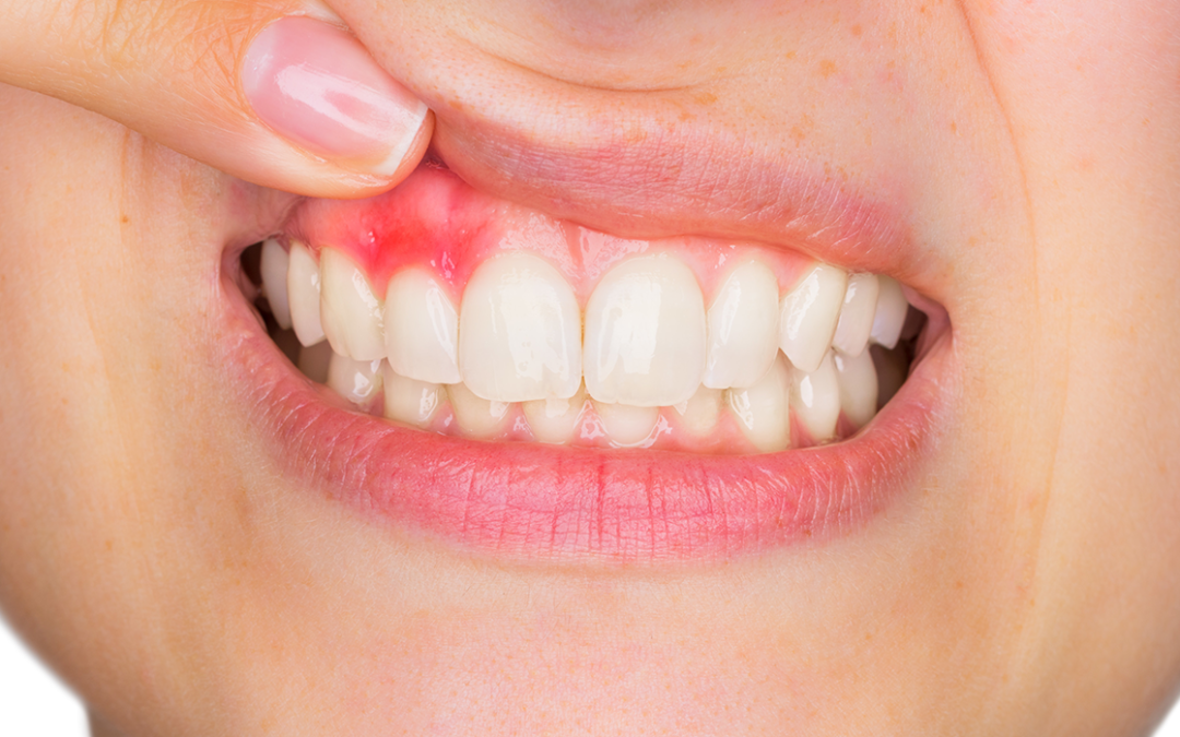 Smiles Central - Latest update - Gum Treatment In Varthur