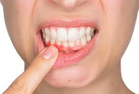 Smiles Central - Latest update - Gum Treatment In Kasavanahalli