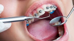 Smiles Central - Latest update - Cure For Dental Aligners In Kasavanahalli