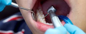 Smiles Central - Latest update - Dental Filling Treatment Near Kasavanahalli