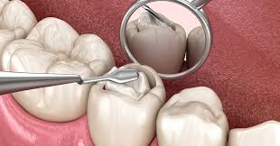 Smiles Central - Latest update - Dental Fillings Treatment In Kasavanahalli
