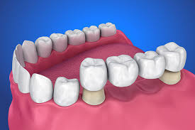 Smiles Central - Latest update - Replacement Of Missing Teeth Dental Near BTM Layout